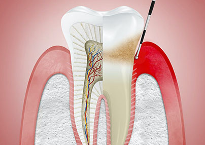 Anadolu Yakası Endodonti Tedavileri