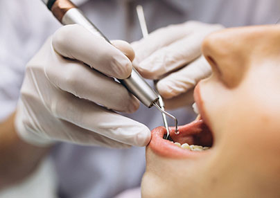 Çekmeköy'de Endodonti Tedavisi Rehberi