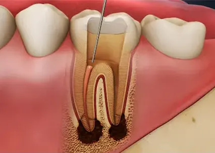 Endodonti