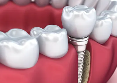 Hasanpaşa'da Diş İmplantı Fiyatları Maliyet ve Ödeme Seçenekleri